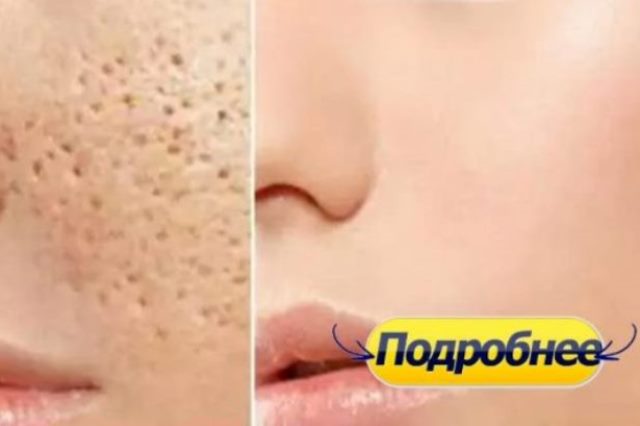 3 ДНЯ И ВСЕ ОТКРЫТЫЕ ПОРЫ ИСЧЕЗНУТ С ВАШЕЙ КОЖИ НАВСЕГДА